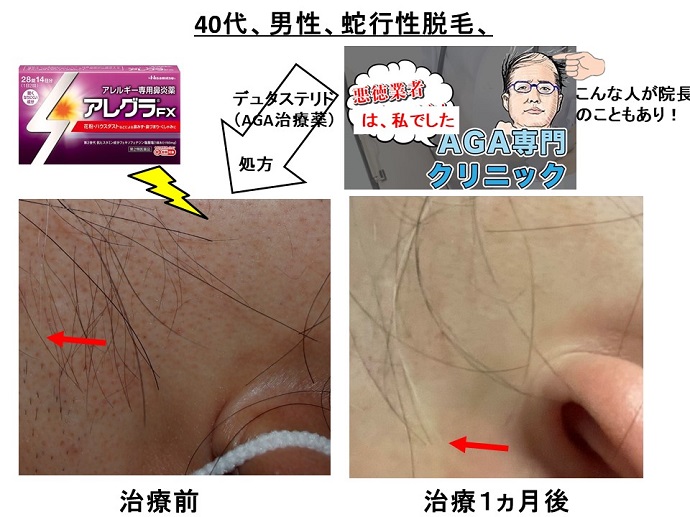 円形脱毛症　病院